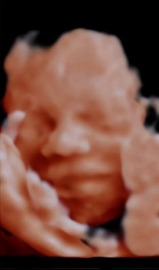 Original 3D ultrasound scan